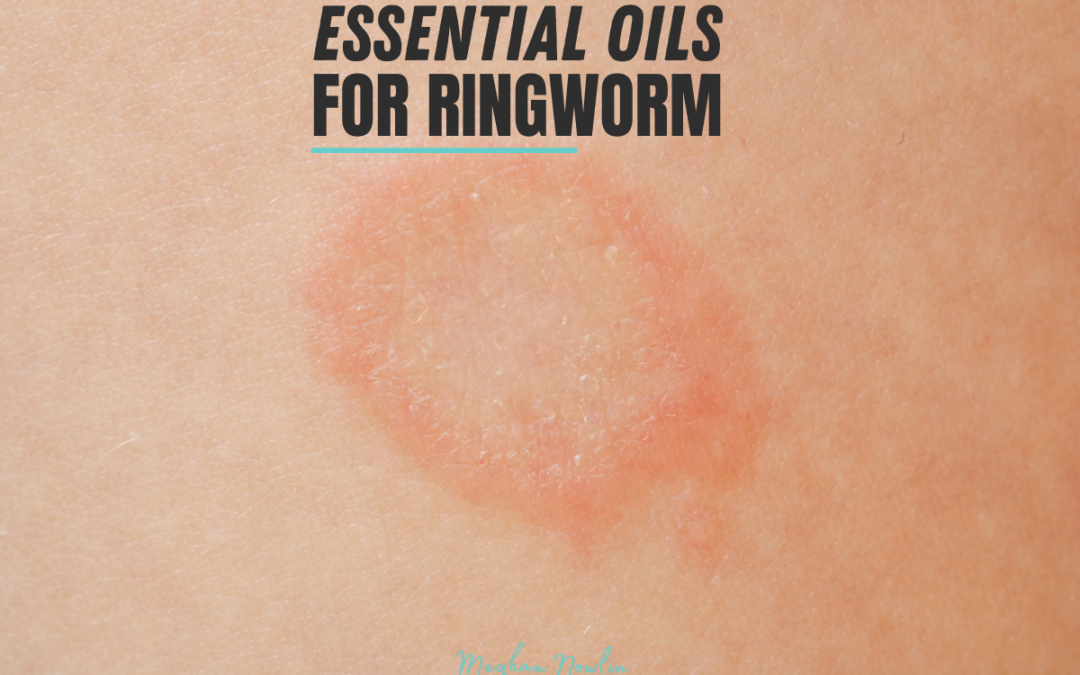 Essential Oils for Ringworm