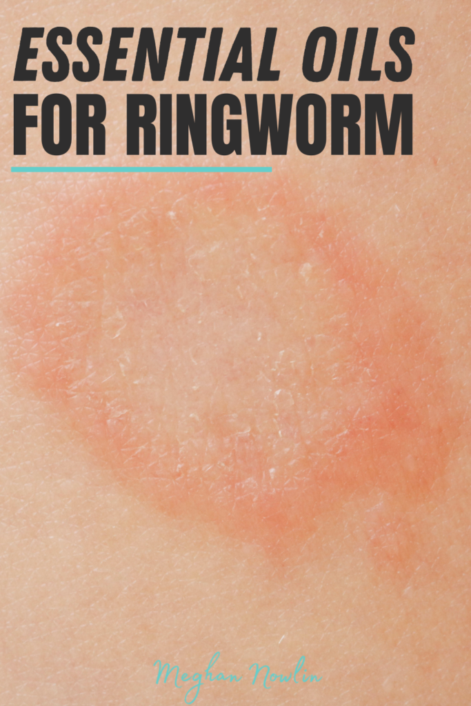 Essential Oils for Ringworm